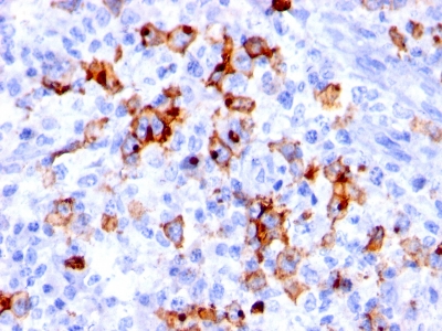 Formalin-fixed, paraffin-embedded human Hodgkin's lymphoma stained with CD15 Monoclonal Antibody (BRA-4F1).