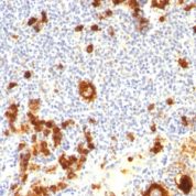 Formalin-fixed, paraffin-embedded human Hodgkin's Lymphoma stained with CD15 Monoclonal Antibody (FUT4/815 + BRA-4F1).