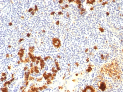 Formalin-fixed, paraffin-embedded human Hodgkin's Lymphoma stained with CD15 Monoclonal Antibody (FUT4/815 + BRA-4F1).