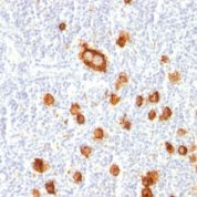 Formalin-fixed, paraffin-embedded human Hodgkin's Lymphoma stained with CD15 Monoclonal Antibody (FUT4/815).