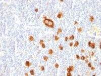 Formalin-fixed, paraffin-embedded human Hodgkin's Lymphoma stained with CD15 Monoclonal Antibody (FUT4/815).