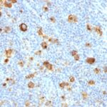 Formalin-fixed, paraffin-embedded human Hodgkin's Lymphoma stained with CD15 Recombinant Rabbit Monoclonal Antibody (FUT4/1478R).