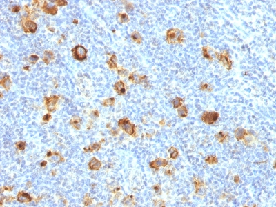 Formalin-fixed, paraffin-embedded human Hodgkin's Lymphoma stained with CD15 Recombinant Rabbit Monoclonal Antibody (FUT4/1478R).