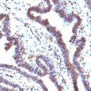 Formalin-fixed, paraffin-embedded human Ovarian carcinoma stained with EMI1 Monoclonal Antibody (EMI1/1176).