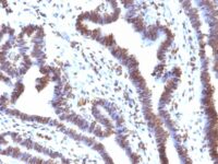 Formalin-fixed, paraffin-embedded human Ovarian carcinoma stained with EMI1 Monoclonal Antibody (EMI1/1176).