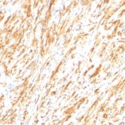 Formalin-fixed, paraffin-embedded human Schwanoma stained with GFAP Monoclonal Antibody (SPM248).
