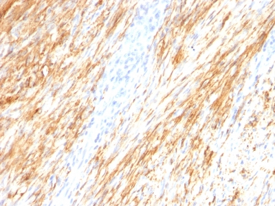 Formalin-fixed, paraffin-embedded human Cerebellum stained with GFAP Monoclonal Antibody (ASTRO/789).