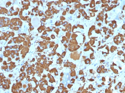 Formalin-fixed, paraffin-embedded Human Pituitary stained with Growth Hormone Monoclonal Antibody (SPM16).