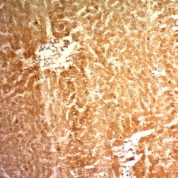 Formalin-fixed, paraffin-embedded human Hepatocellular Carcinoma stained with Glypican-3 Monoclonal Antibody (1G12)