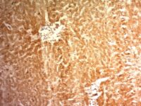 Formalin-fixed, paraffin-embedded human Hepatocellular Carcinoma stained with Glypican-3 Monoclonal Antibody (1G12)