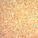 Formalin-fixed, paraffin-embedded human Melanoma stained with Glypican-3 Monoclonal Antibody (SPM595)