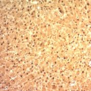 Formalin-fixed, paraffin-embedded human Melanoma stained with Glypican-3 Monoclonal Antibody (SPM595)