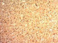 Formalin-fixed, paraffin-embedded human Melanoma stained with Glypican-3 Monoclonal Antibody (SPM595)