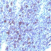 Formalin-fixed, paraffin-embedded human Melanoma stained with Glypican-3 Monoclonal Antibody (1G12 + GPC3/863)
