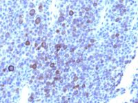 Formalin-fixed, paraffin-embedded human Melanoma stained with Glypican-3 Monoclonal Antibody (1G12 + GPC3/863)