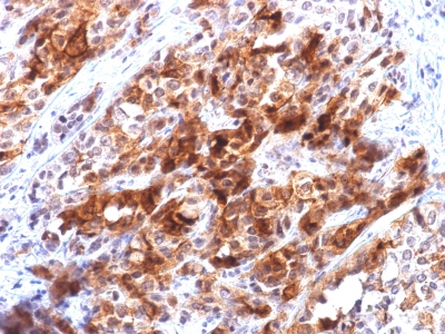 Formalin-fixed, paraffin-embedded human Hepatocellular Carcinoma stained with Glypican-3 Recombinant Mouse Monoclonal Antibody (rGPC3/863).