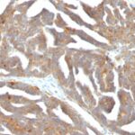 Formalin-fixed, paraffin-embedded human Ovarian Carcinoma stained with GnRH-Receptor Monoclonal Antibody (F1G4)