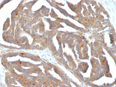 Formalin-fixed, paraffin-embedded human Ovarian Carcinoma stained with GnRH-Receptor Monoclonal Antibody (F1G4)