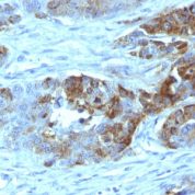 Formalin-fixed, paraffin-embedded human Colon Carcinoma stained with Blood Group Antigen H Type 2 Monoclonal Antibody (19-OLE)