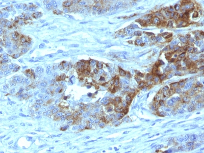 Formalin-fixed, paraffin-embedded human Colon Carcinoma stained with Blood Group Antigen H Type 2 Monoclonal Antibody (19-OLE)