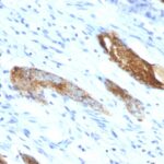 Formalin-fixed, paraffin-embedded human Colon Carcinoma stained with Blood Group Antigen A Monoclonal Antibody (33C13)