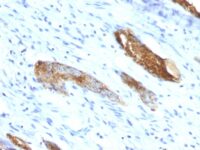 Formalin-fixed, paraffin-embedded human Colon Carcinoma stained with Blood Group Antigen A Monoclonal Antibody (33C13)