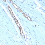 Formalin-fixed, paraffin-embedded human Colon Carcinoma stained with Blood Group Antigen A Monoclonal Antibody (HE-193)