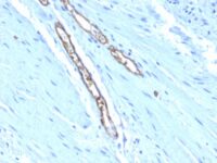 Formalin-fixed, paraffin-embedded human Colon Carcinoma stained with Blood Group Antigen A Monoclonal Antibody (HE-193)