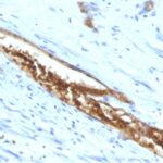 Formalin-fixed, paraffin-embedded human Colon Carcinoma stained with Blood Group Antigen A Monoclonal Antibody (3-3A)