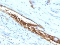 Formalin-fixed, paraffin-embedded human Colon Carcinoma stained with Blood Group Antigen A Monoclonal Antibody (3-3A)