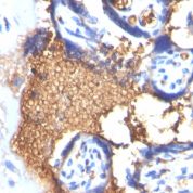 Formalin-fixed, paraffin-embedded human Angiosarcoma stained with Glycophorin A Monoclonal Antibody (GYPA/28)