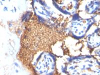 Formalin-fixed, paraffin-embedded human Angiosarcoma stained with Glycophorin A Monoclonal Antibody (GYPA/28)