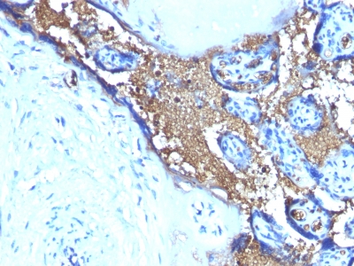Formalin-fixed, paraffin-embedded human Angiosarcoma Stained with Glycophorin A Monoclonal Antibody (SPM599)