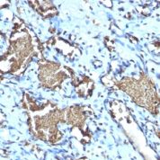 Formalin-fixed, paraffin-embedded human Angiosarcoma stained with Recombinant Rabbit Monoclonal Antibody (GYPA/1725R)