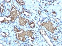 Formalin-fixed, paraffin-embedded human Angiosarcoma stained with Recombinant Rabbit Monoclonal Antibody (GYPA/1725R)