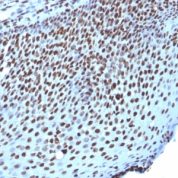Formalin-fixed, paraffin-embedded human Ovarian Carcinoma stained with Histone H1 Monoclonal Antibody (AE-4)