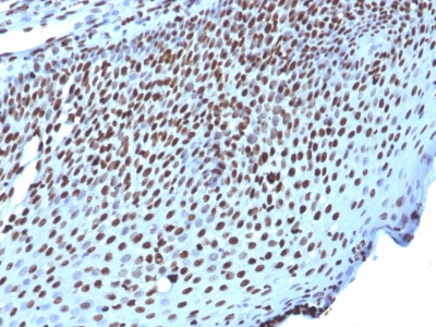Formalin-fixed, paraffin-embedded human Ovarian Carcinoma stained with Histone H1 Monoclonal Antibody (AE-4)