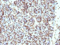 Formalin-fixed, paraffin-embedded human Ovarian Carcinoma stained with Histone H1 Monoclonal Antibody (HH1/957)