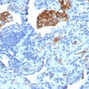 Formalin-fixed, paraffin-embedded human Colon Carcinoma stained with CD29 Monoclonal Antibody (C29/1781).