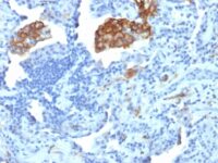 Formalin-fixed, paraffin-embedded human Colon Carcinoma stained with CD29 Monoclonal Antibody (C29/1781).