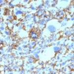 Formalin-fixed, paraffin-embedded human Histiocytoma stained with HLA-DRB Monoclonal Antibody (SPM423).