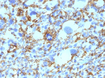 Formalin-fixed, paraffin-embedded human Histiocytoma stained with HLA-DRB Monoclonal Antibody (SPM423).