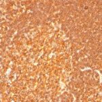 Formalin-fixed, paraffin-embedded human Histiocytoma stained with HLA-DR Monoclonal Antibody (LN-3 + HLA-DRB/167).