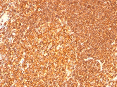 Formalin-fixed, paraffin-embedded human Histiocytoma stained with HLA-DR Monoclonal Antibody (LN-3 + HLA-DRB/167).