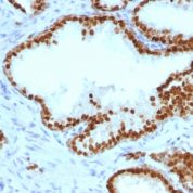 Formalin-paraffin human Bladder Carcinoma stained with FOXA1 Monoclonal Antibody (FOXA1/1241).