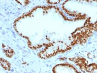 Formalin-paraffin human Bladder Carcinoma stained with FOXA1 Monoclonal Antibody (FOXA1/1241).