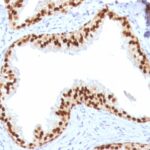 Formalin-fixed, paraffin-embedded human Prostate Carcinoma stained with FOXA1 Monoclonal Antibody (FOXA1/1512).