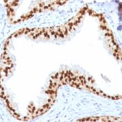 Formalin-fixed, paraffin-embedded human Prostate Carcinoma stained with FOXA1 Monoclonal Antibody (FOXA1/1512).