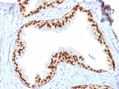 Formalin-fixed, paraffin-embedded human Prostate Carcinoma stained with FOXA1 Monoclonal Antibody (FOXA1/1512).