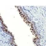 Formalin-fixed, paraffin-embedded human Prostate Carcinoma stained with FOXA1 Monoclonal Antibody (FOXA1/1514).